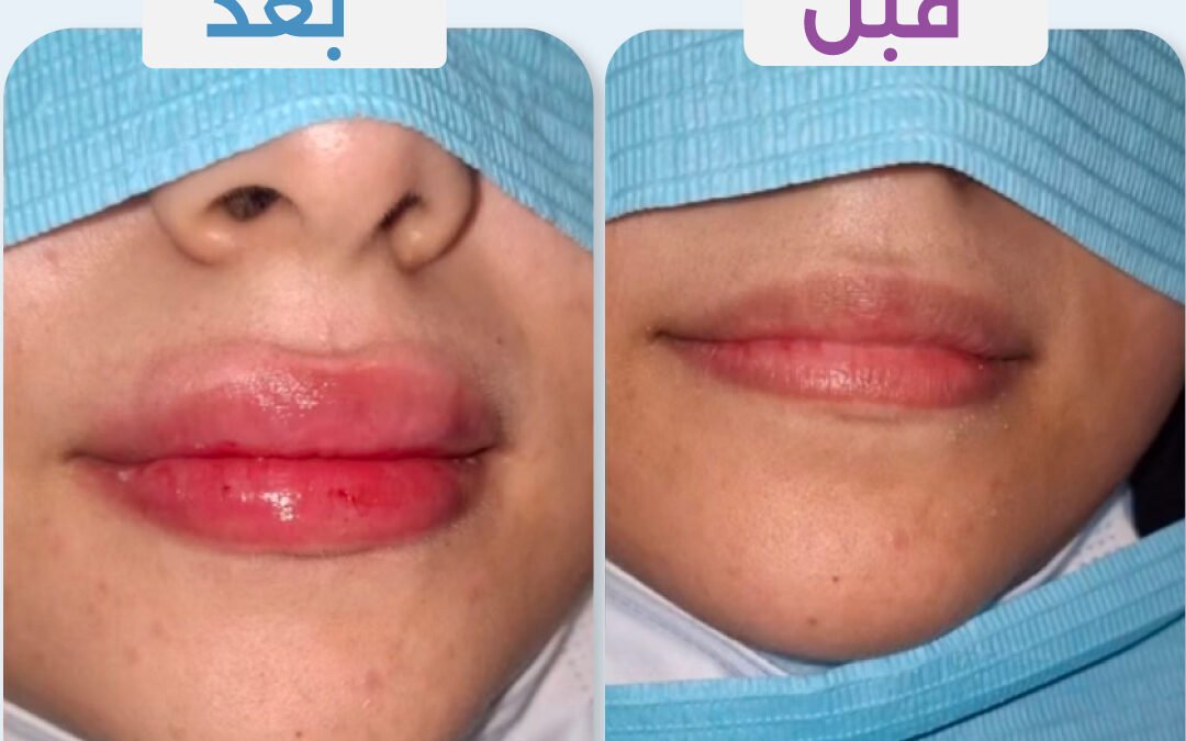 فيلر شفايف