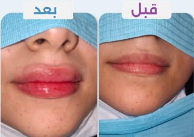 فيلر شفايف
