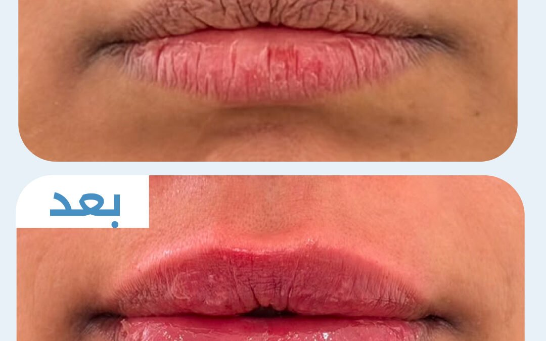 فيلر شفايف
