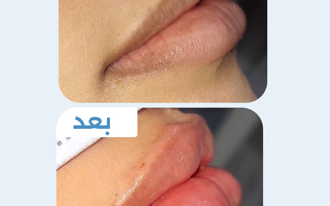 فيلر شفايف