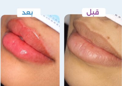 فيلر شفايف